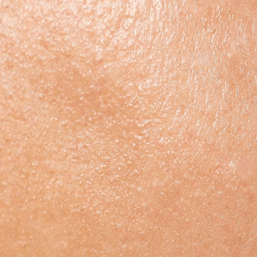 pelle impura | Istituto di Estetica Paola Dibi Center | Estetica avanzata Montecchio Maggiore dal 1984