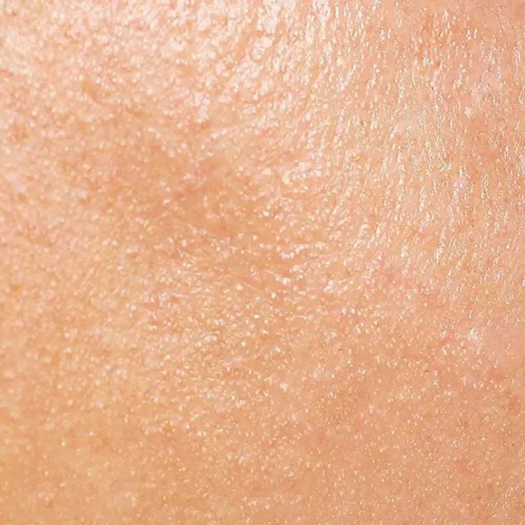 pelle impura | Istituto di Estetica Paola Dibi Center | Estetica avanzata Montecchio Maggiore dal 1984